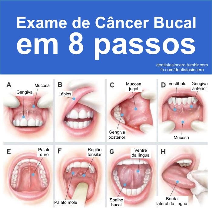 8 passos p exame de cancer bucal